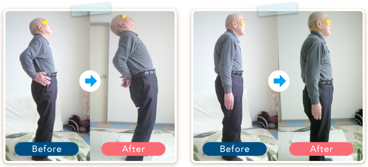 80代男性の施術前後の姿勢と可動域の変化